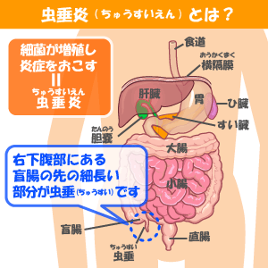 東京都こども医療ガイド 虫垂炎 ちゅうすいえん 盲腸 もうちょう